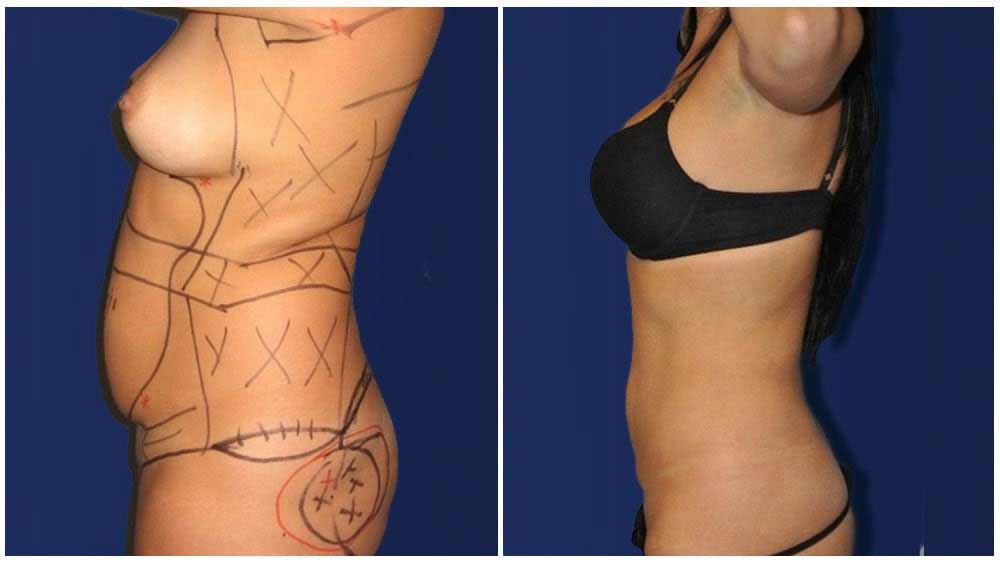 Fat Transfer of a Minneapolis Liposuction Specialty Clinic Female Patient - (30 years)