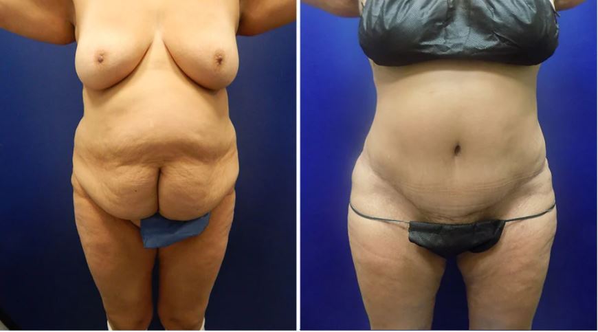 Mini Tummy Tuck Technique - Minneapolis, MN